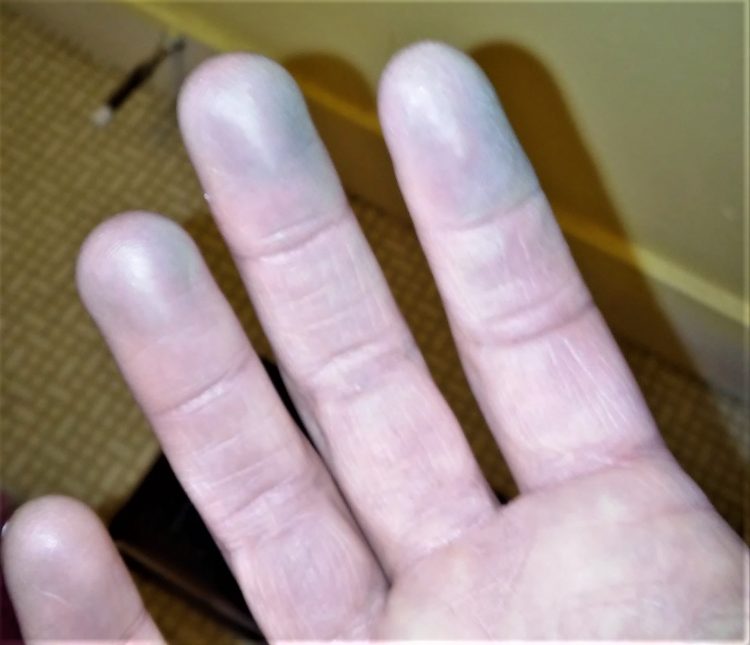 Author's hands turning blue