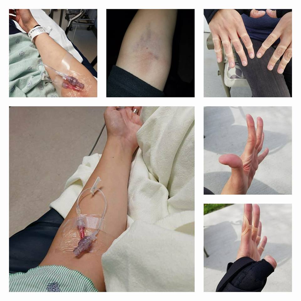 photo collage for woman receiving IVs, getting blood drawn and hyperextending her finger joints