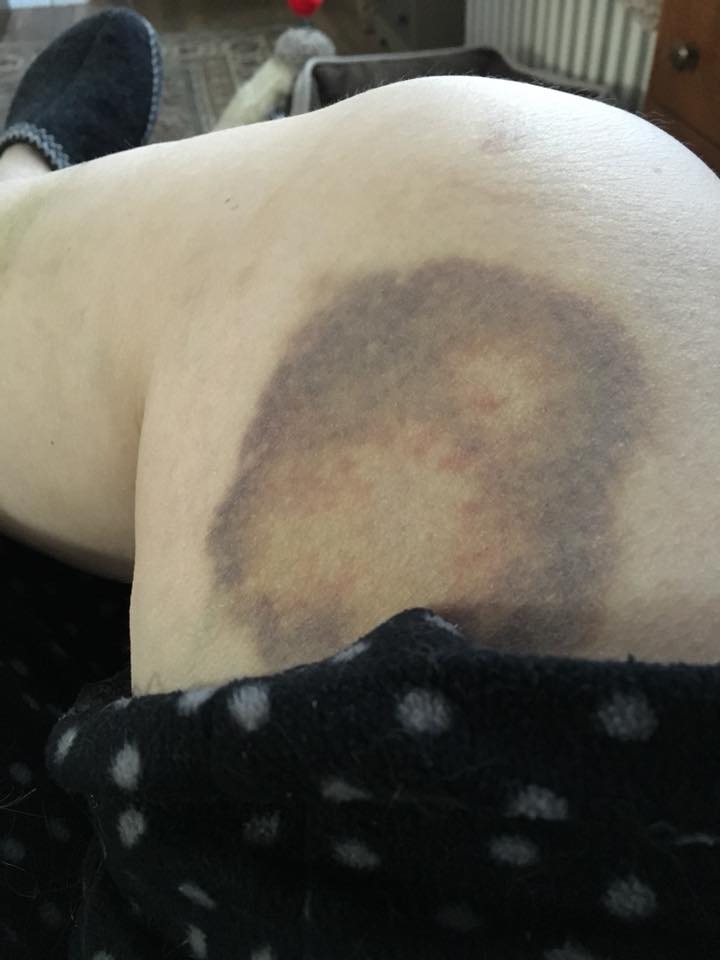 large bruise on a woman's inner thigh