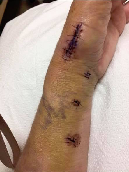 scars and bruising on a woman's skin after surgery