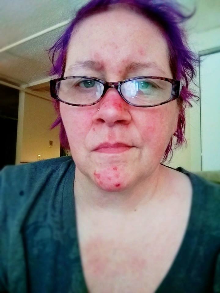 woman wearing glasses with a red rash on her face from lupus
