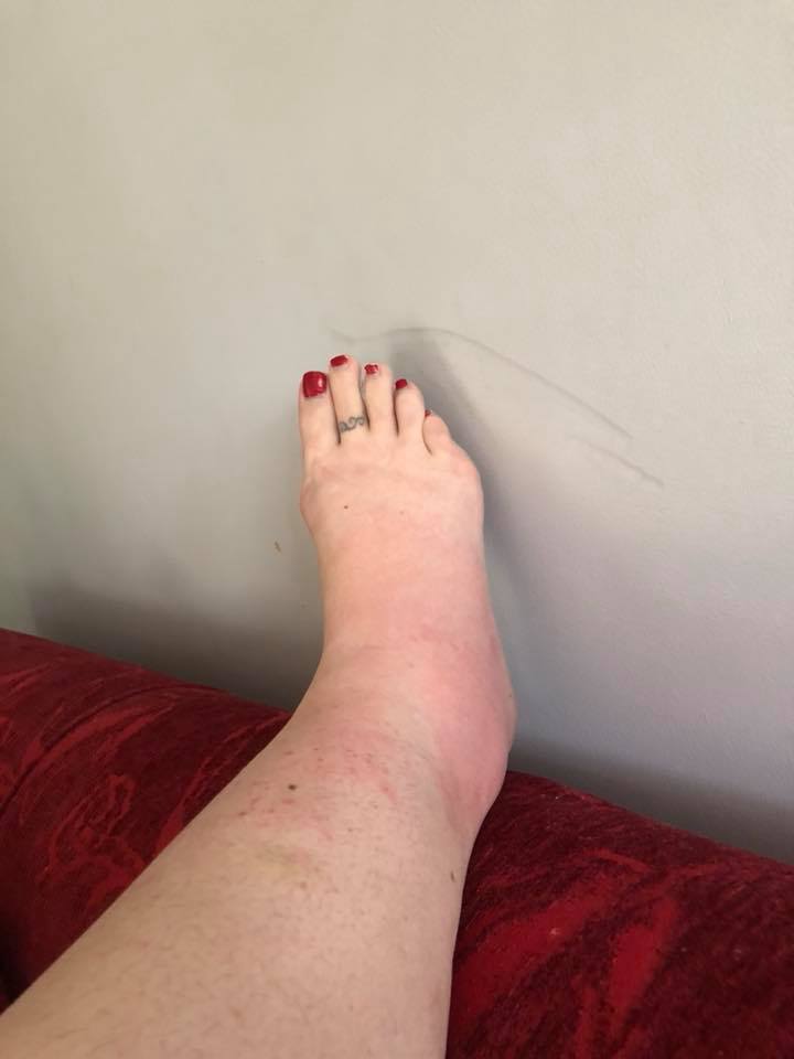 a woman's swollen and red ankle and foot