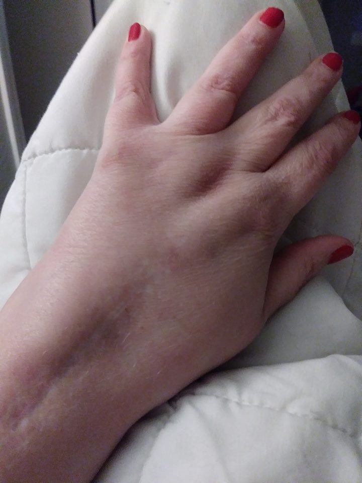 scars on a woman's hand from surgery