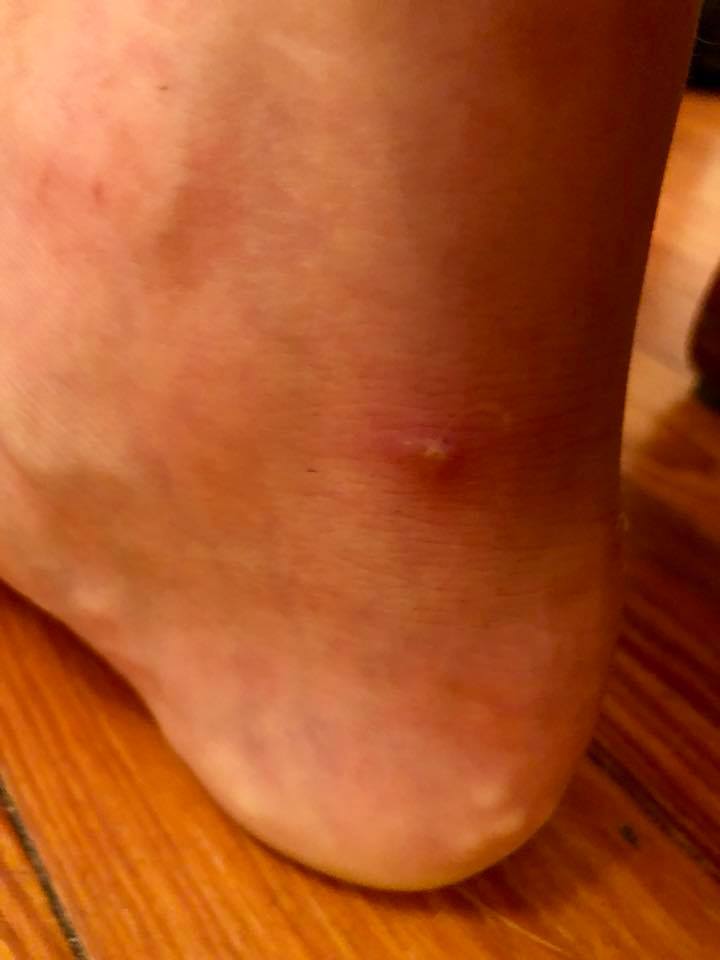Piezogenic papule on a woman's heel