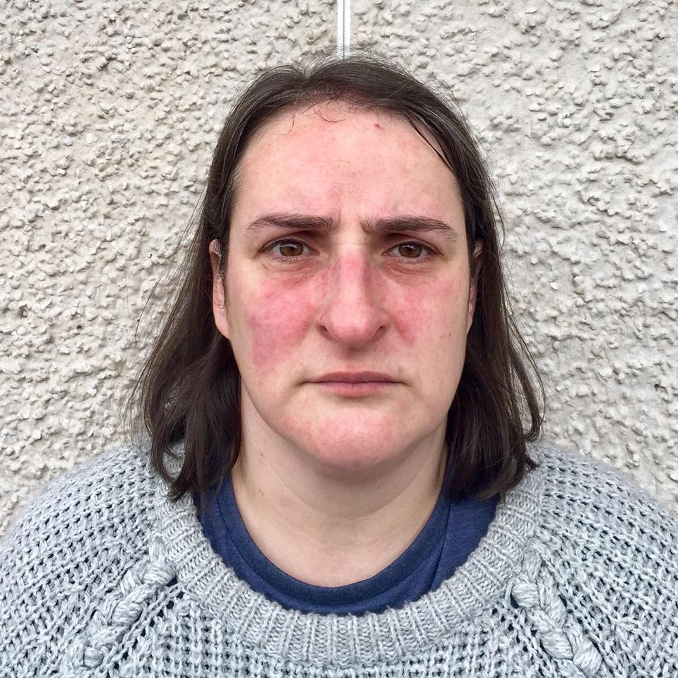 woman standing against a wall wearing a gray sweater with a butterfly rash across her cheeks