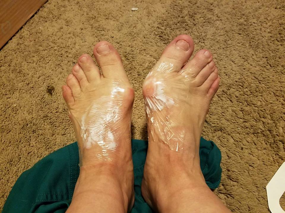 woman's feet covered in lidocaine