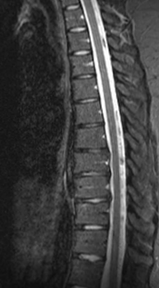MRI of a woman's spine