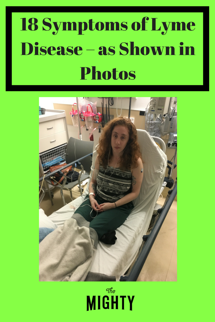 18 Symptoms of Lyme Disease in Photos The Mighty