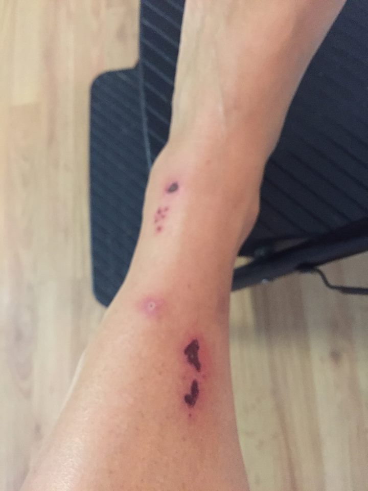 red rash on a woman's leg