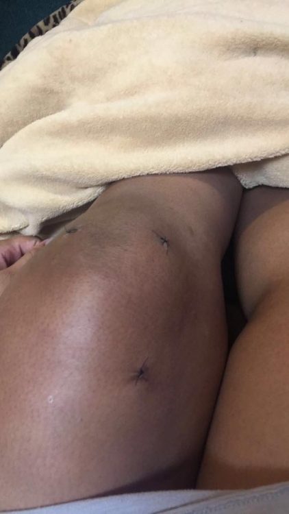 woman's knees with scars and stitches from surgery