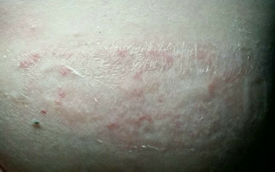 rash on a woman's skin