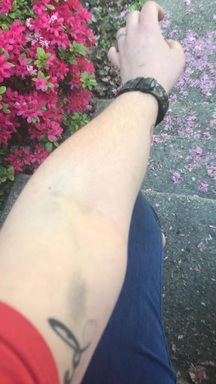 woman's arm with large bruises
