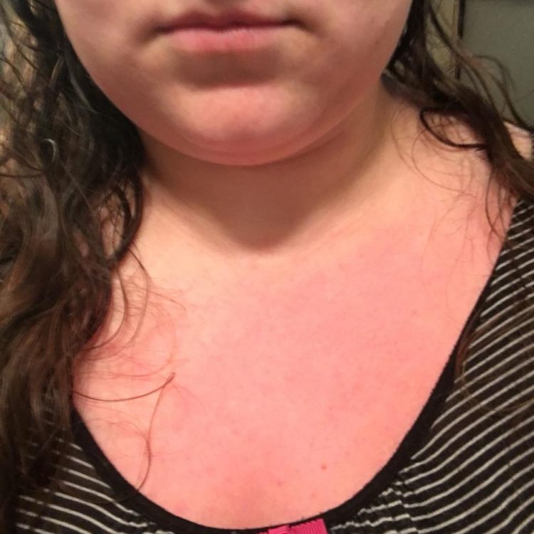 woman's chest covered in red rash