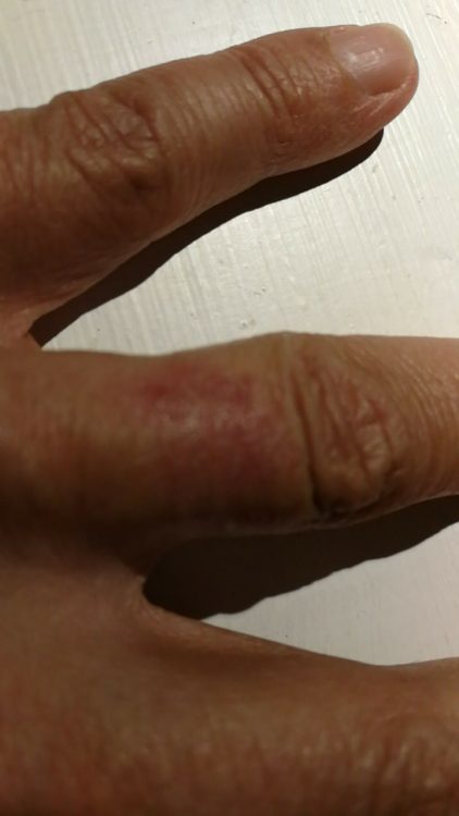 fingers with rash on ring finger