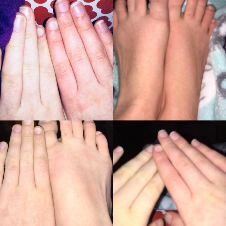 hands and feet showing redness due to blood pooling