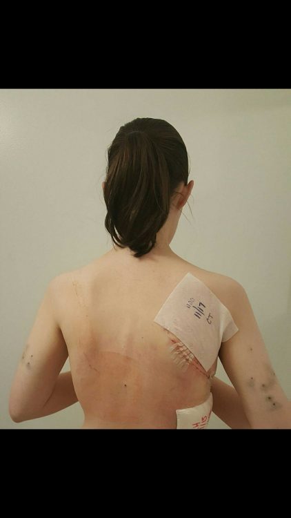 woman's back with bandage on shoulder