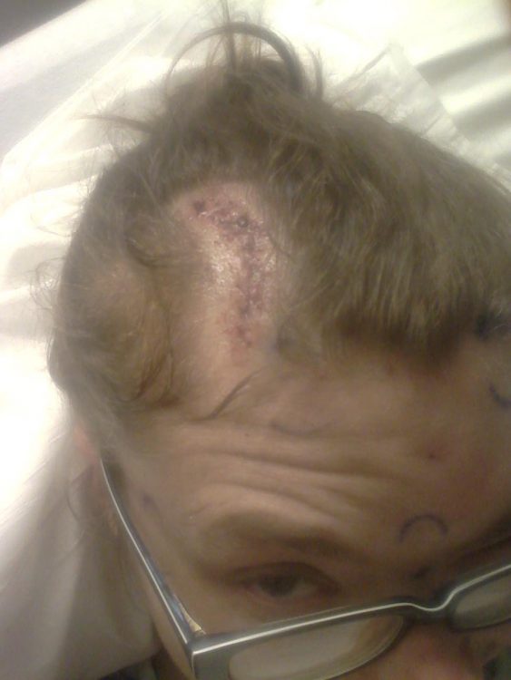 A scar on Christina's head after shunt surgery 