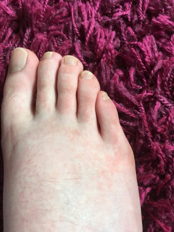 foot with red rash on toes