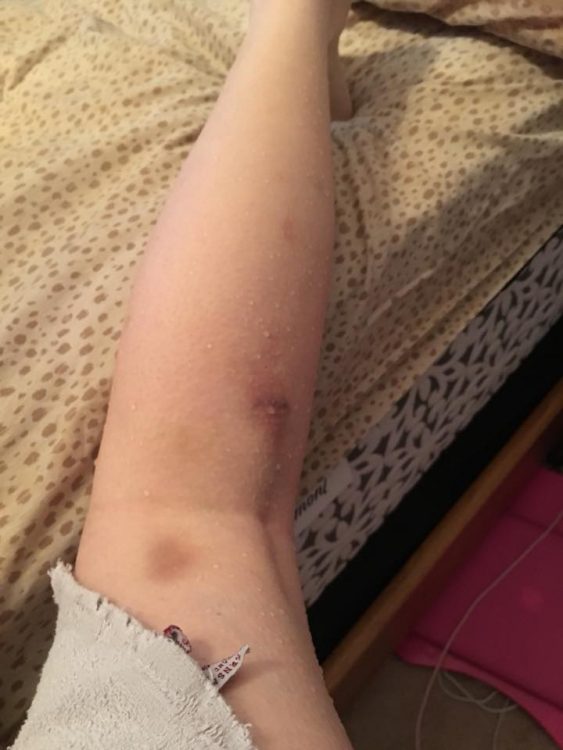leg with bruises