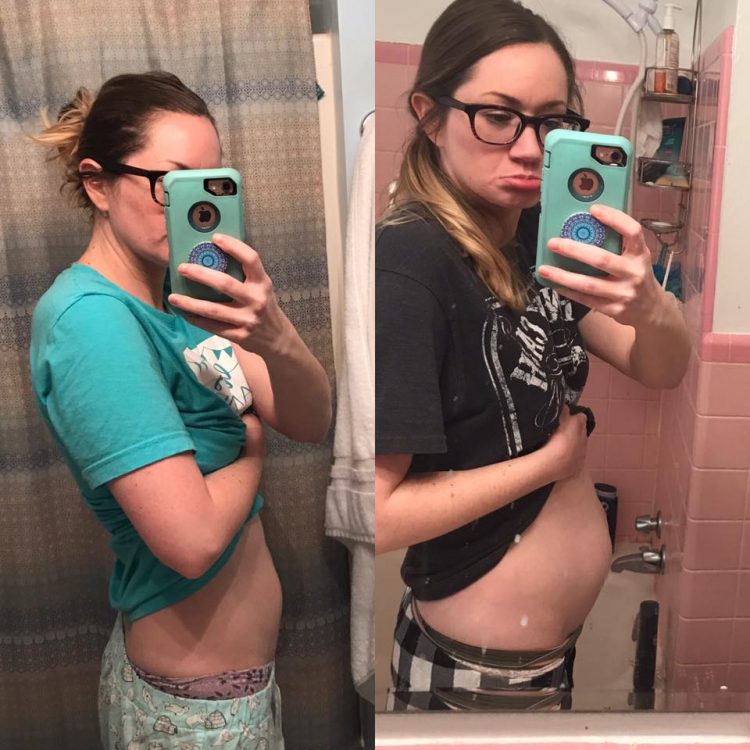 side by side photos of woman before and after swollen stomach