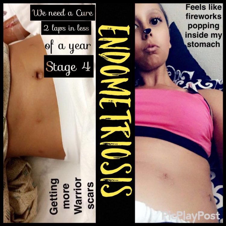 two photos of woman's stomach
