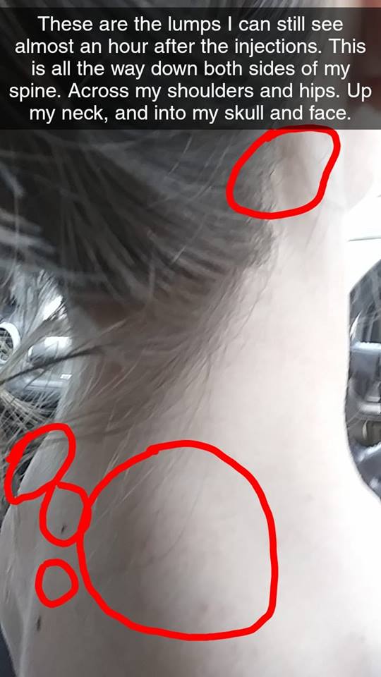 the back of a woman's head with lumps circled from injection sites