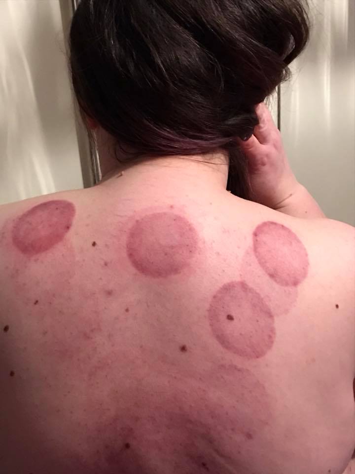 woman with red circles on her back from cupping