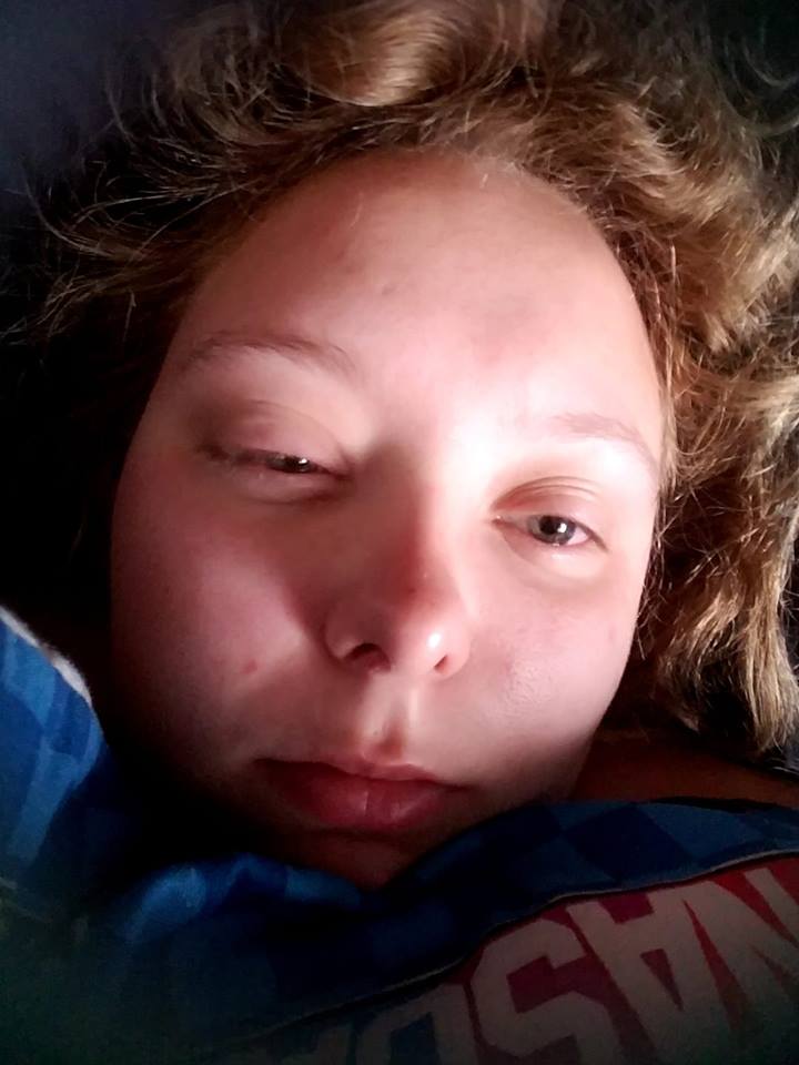 woman lying in bed with swollen eyes