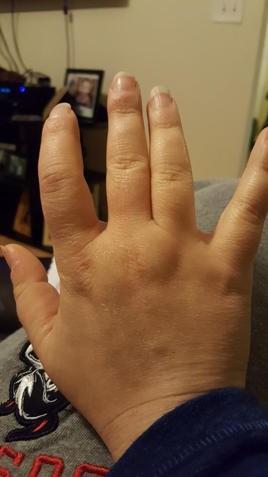 woman holding up her swollen right hand