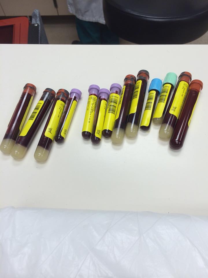 13 vials of blood lying on a table