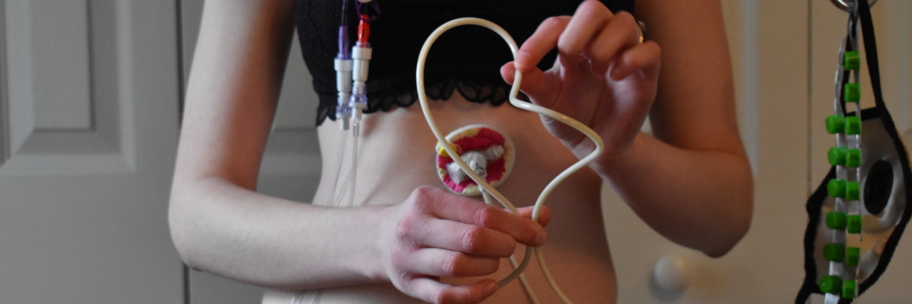 woman holding GJ feeding tube in front of her abdomen