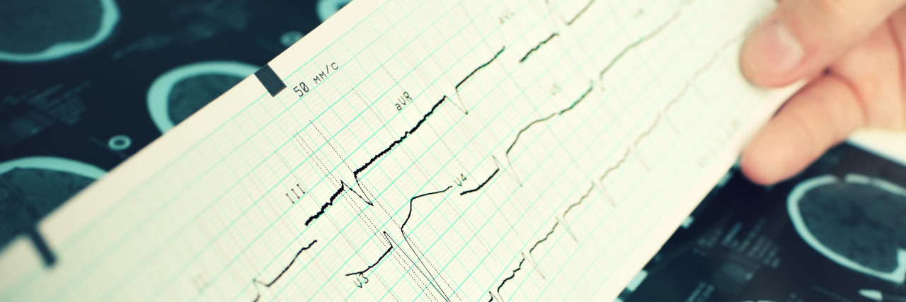 Living With Difficult to Detect Epilepsy Looking at EEG results.