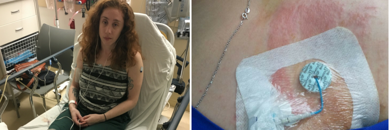 18 Symptoms of Lyme Disease in Photos woman sitting in a hospital bed, and a port in a woman's chest connected to an IV