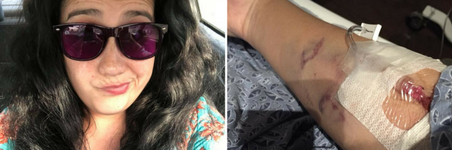 22 Photos That Show What Lupus Really Looks Like