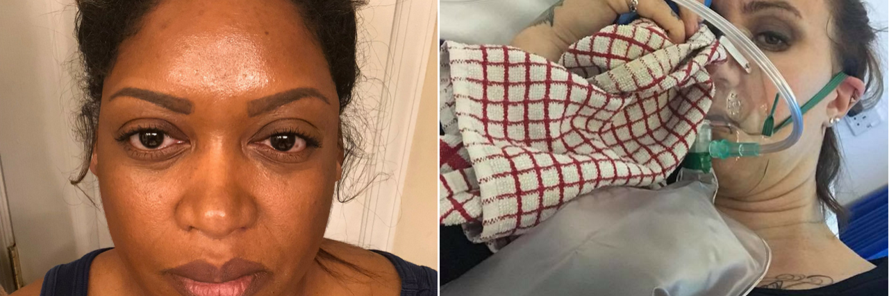 14 Symptoms of Migraine in Photos woman taking a selfie showing one of her eyes drooping during a migraine attack and woman lying in a hospital bed wearing an oxygen mask and holding a rag