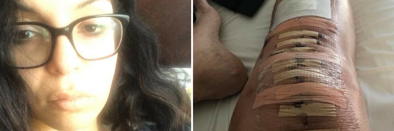 woman wearing glasses taking a selfie, and photo of stitches and bandages across a woman's knee after surgery