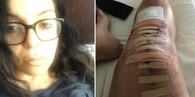 woman wearing glasses taking a selfie, and photo of stitches and bandages across a woman's knee after surgery