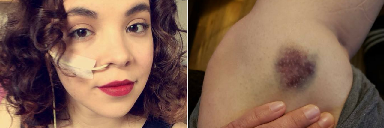19 Photos of Ehlers-Danlos Syndrome Side Effects We Don't Talk About woman with a tube in her nose, and woman with a bruise on her skin