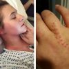 woman in hospital gown with mcas and hand with bad stitches scar