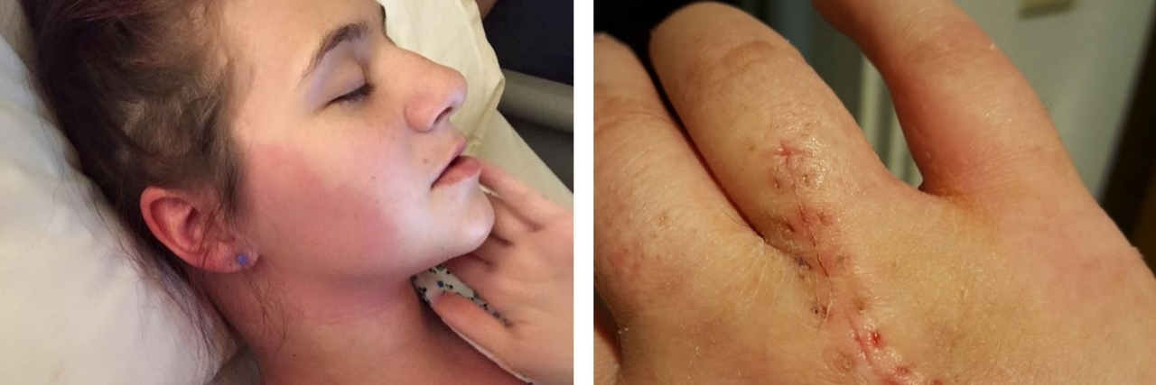 10 Photos of Little-Known Symptoms of Ehlers-Danlos Syndrome woman in hospital gown with mcas and hand with bad stitches scar