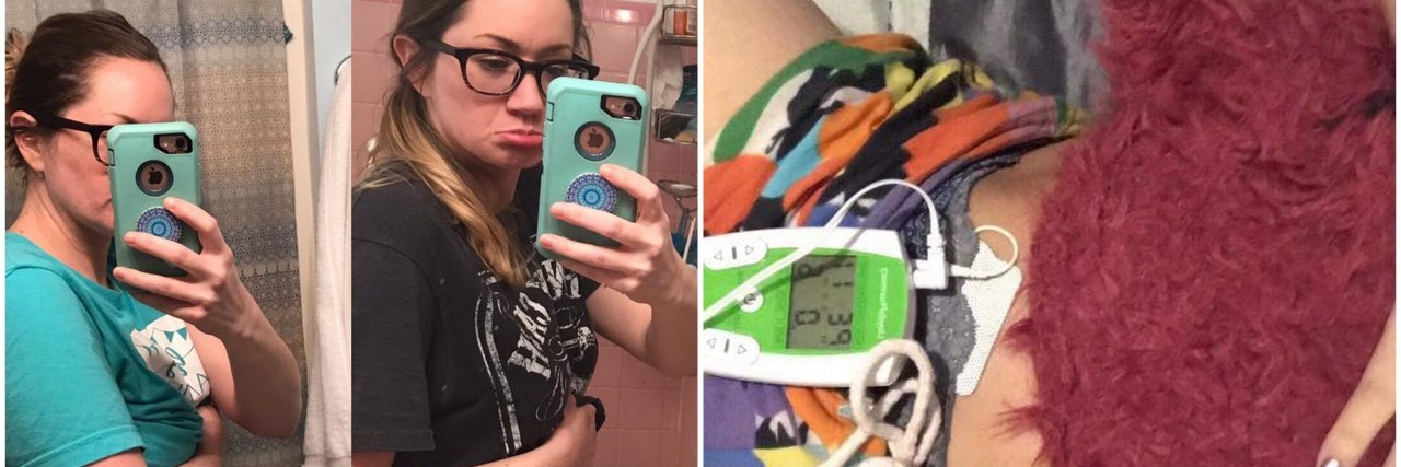 16 Photos That Show What Endometriosis Really Looks Like girl showing before and after with endo belly and girl with tens unit on stomach