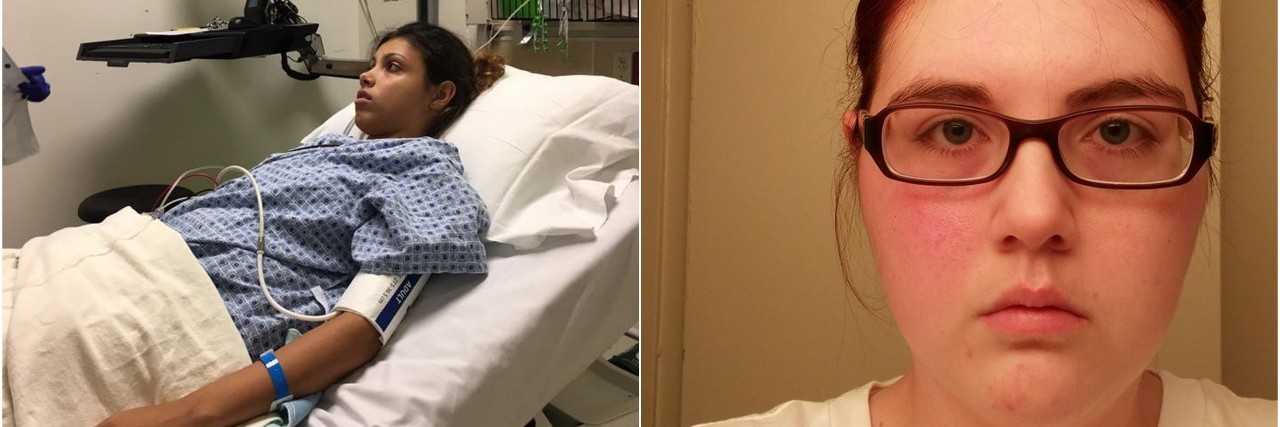13 Little-Known Symptoms of Dysautonomia in Photos woman in hospital bed and woman with half of face rash