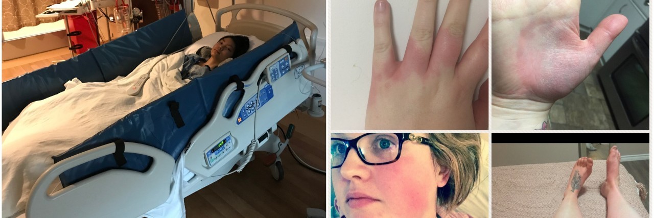 girl in hospital bed and collage of hands and face with red rash