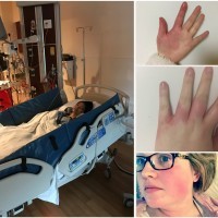 girl in hospital bed and collage of hands and face with red rash