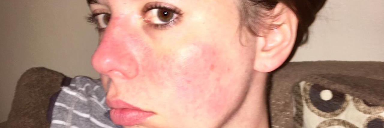 A photo of th writer, her face showing red splotches.