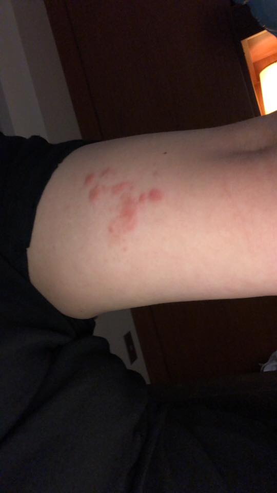 red bumpy rash on a woman's arm