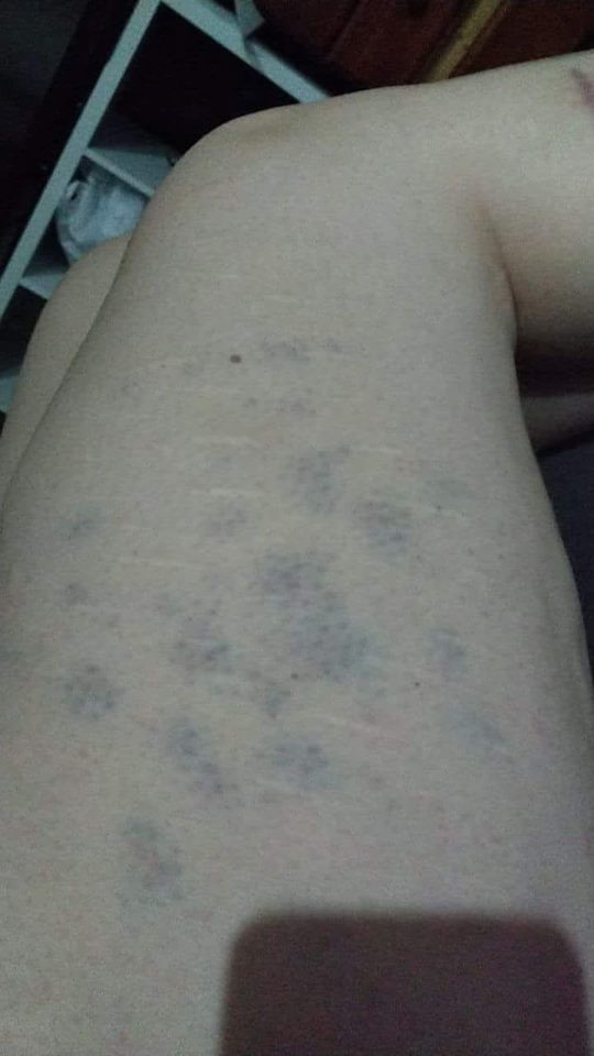bruises on a woman's leg