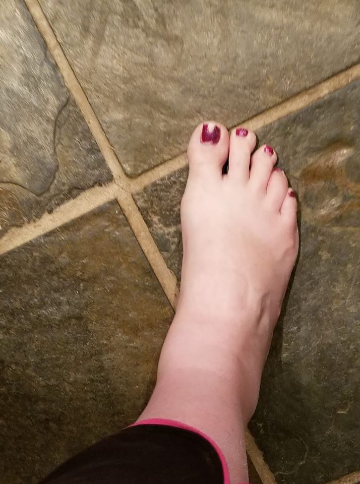 woman's swollen foot and ankle