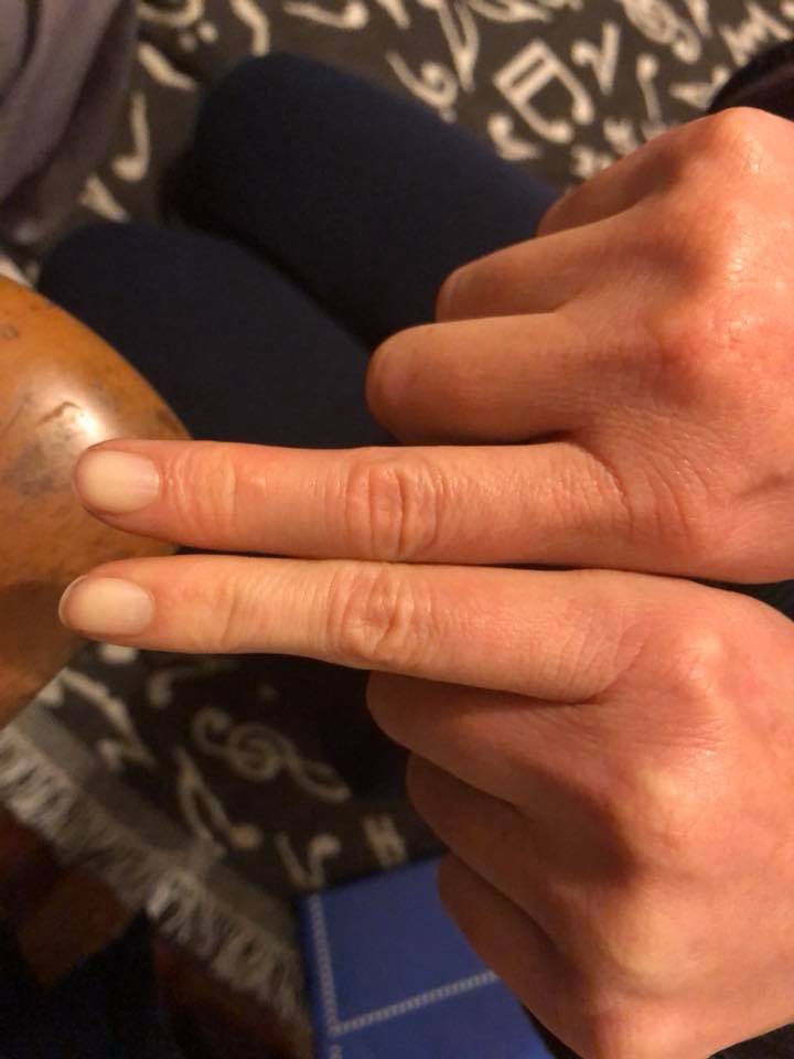 woman's swollen fingers