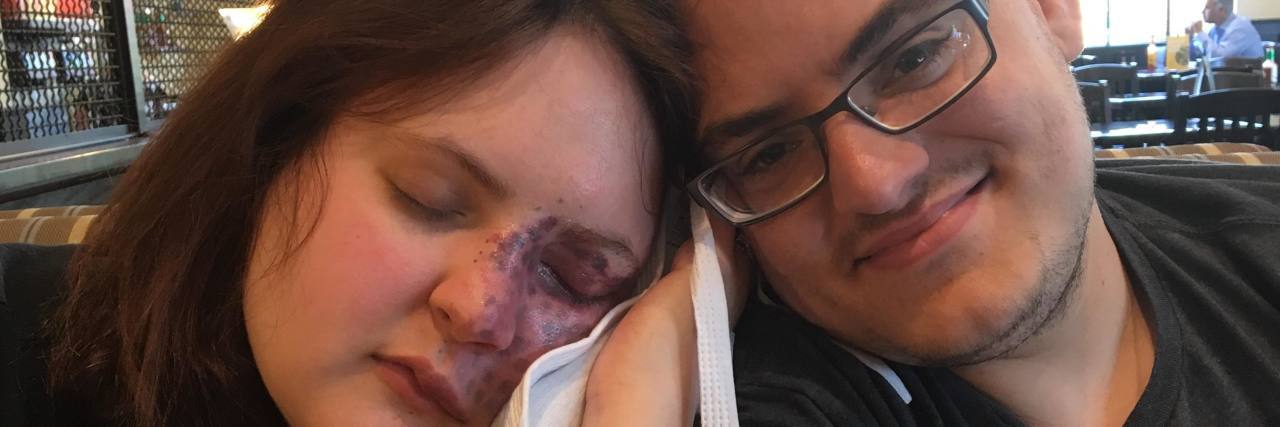 How My Fiancé Supports Me, My Birthmark and Laser Treatments A photo of Crystal and her fiance, as Crystal leans on him while holding an icepack to her face.
